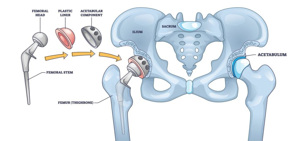 hip replacement